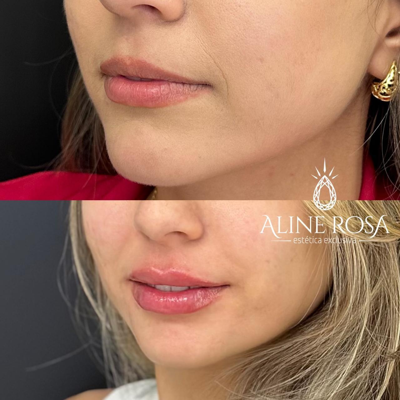 Estruturação Labial